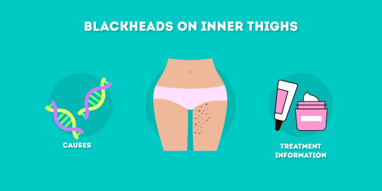 Blackheads-on-Inner-Thighs-Causes-and-Treatment-Information