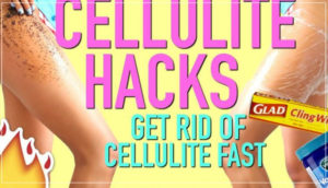 Cellulite