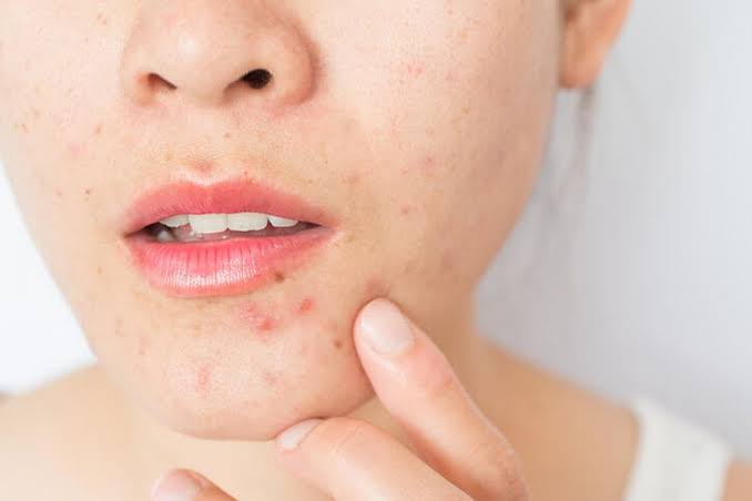 How to help prevent acne, blackheads and blemishes