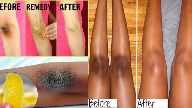 Quick natural recipes to whiten knees and elbows