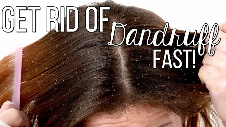 Get rid of dandruff from your hair with these ingredients