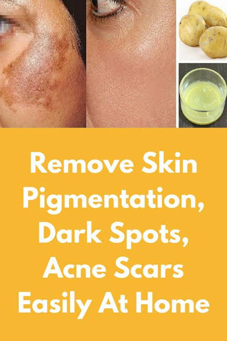 How Can I Remove Dark Spots at Home Naturally?