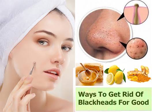 7 ways to completely get rid of blackheads!