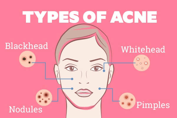 The 5 easiest home ways to treat acne at home
