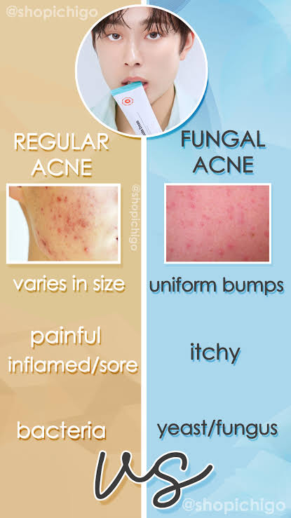 What is Fungal Acne: Treatment and Triggering Ingredients