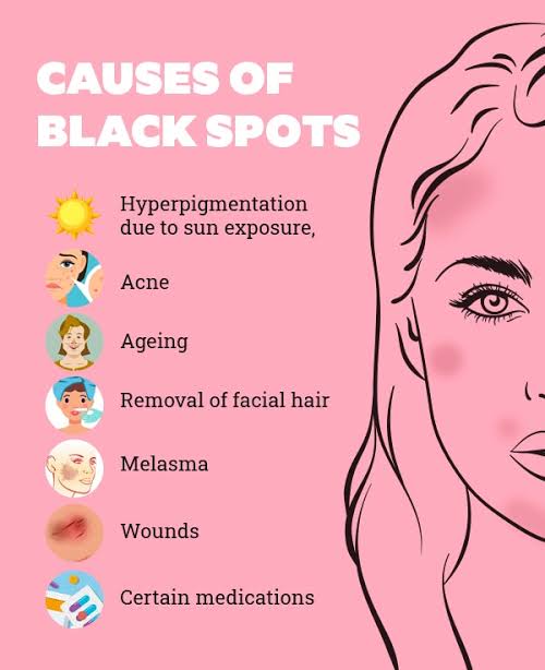 The reason behind the skin spots has been revealed! Here’s everything that causes skin blemishes