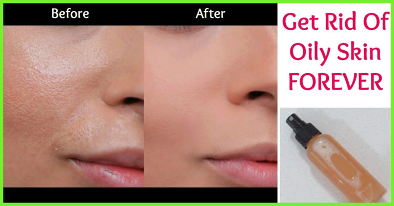 7-Effective-Home-Remedies-to-Get-Rid-Of-Oily-Skin