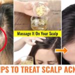 Causes and treatment of scalp pimples
