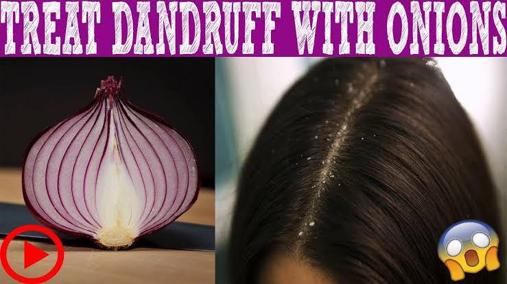 Dandruff treatment with onion juice recipe