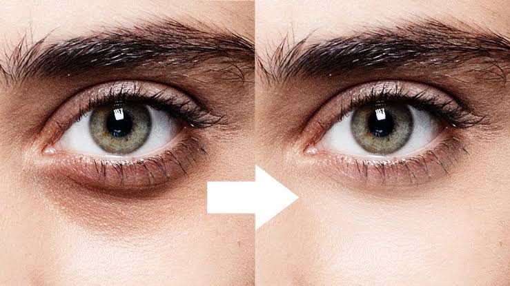 Eliminate Under-Eye Bruises