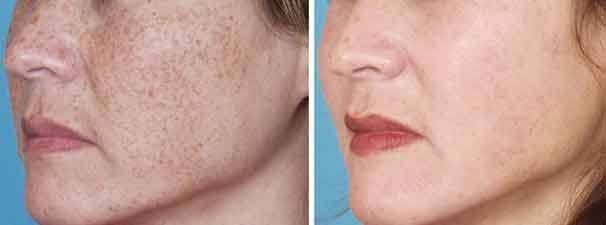 You will never suffer from melasma spots again, here you find the final solution