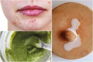 Ayurvedic-Ingredients-To-Clear-Acne