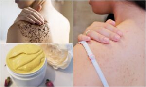 Treat-Pimples-on-the-Back