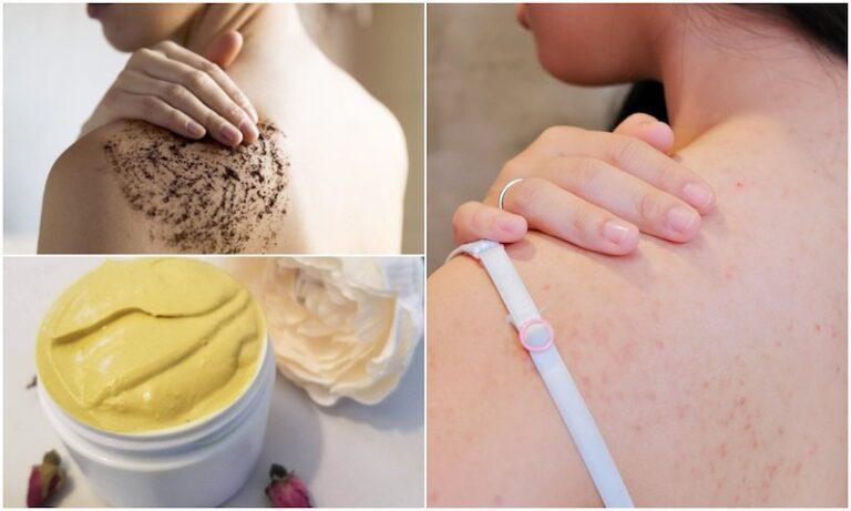 Treat-Pimples-on-the-Back