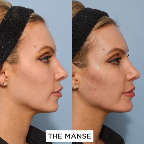Jaw Filler: All you need to know