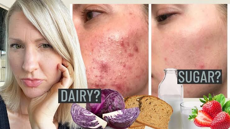 Are there foods that treat acne?