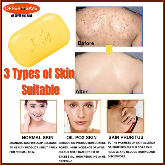 Benefits of sulfur soap for psoriasis