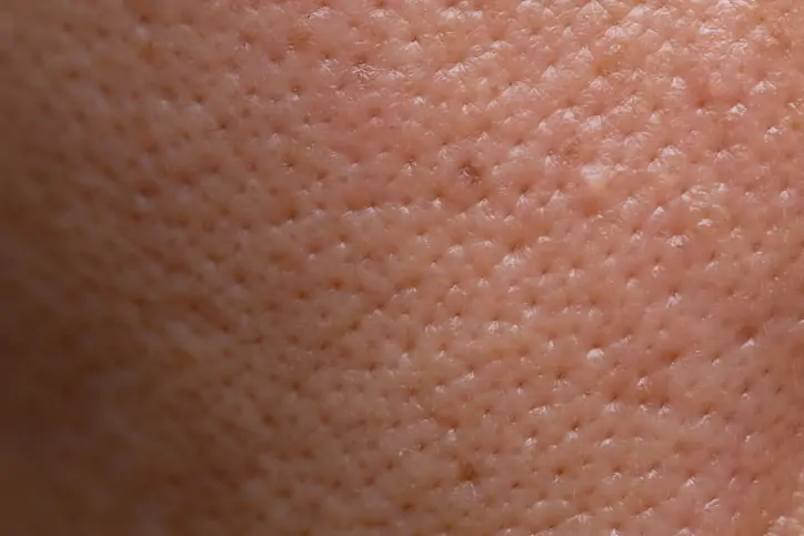 An example of enlarged pores on the cheeks