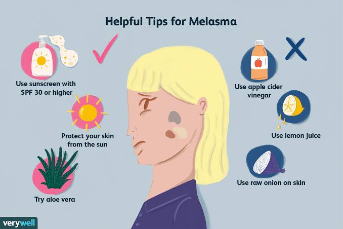 Melasma treatment and why do you get it? And ways to stop its spread