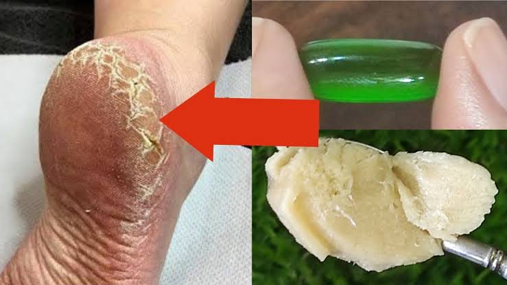 A natural recipe to eliminate cracked feet in a few minutes