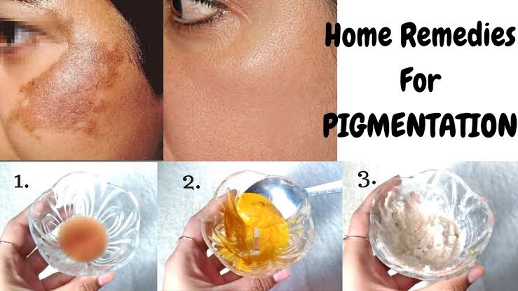 Natural ways to remove skin pigmentation and dark spots