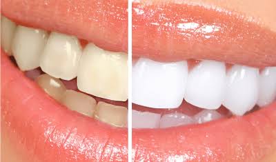 You will not suffer from yellowing teeth after trying this powerful mixture