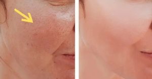 خلطات-منزلية-للتخلص-من-مسامات-البشرة-الواسعة