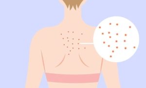 خلطات-للتخلص-على-بثور-الظهر-بطريقة-سهلة-وبسيطة-780x470