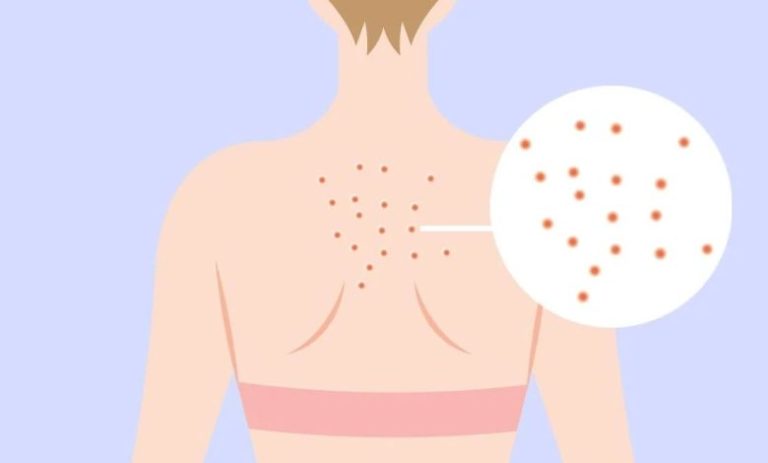 خلطات-للتخلص-على-بثور-الظهر-بطريقة-سهلة-وبسيطة-780x470