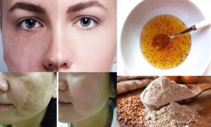 كيفية-عمل-خلطات-لإزالة-الكلف-780x470