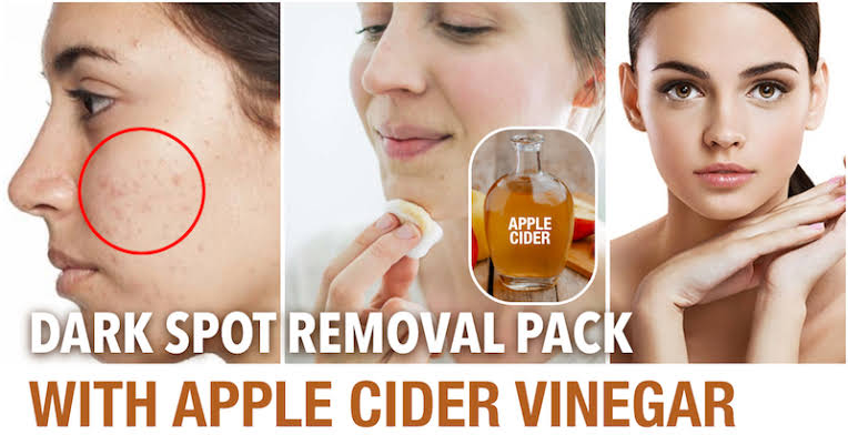 Say goodbye to acne and blemishes with apple cider vinegar