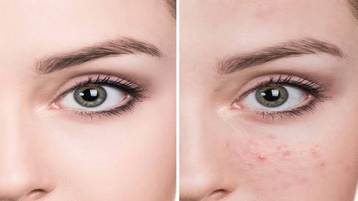 To hide pimples and scars from your face, these methods are for you