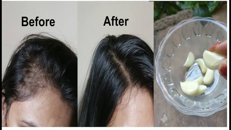 Hair loss treatment with a natural garlic mixture