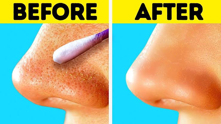 5 proven and effective steps to get rid of blackheads