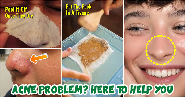 A magical herb to eliminate pimples permanently
