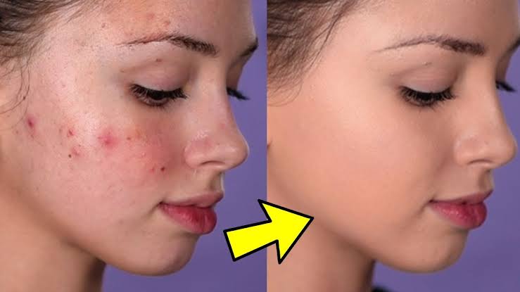 Hide the effects of acne with makeup in these ways