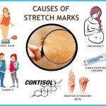 How to Treat Stretch Marks on the Body