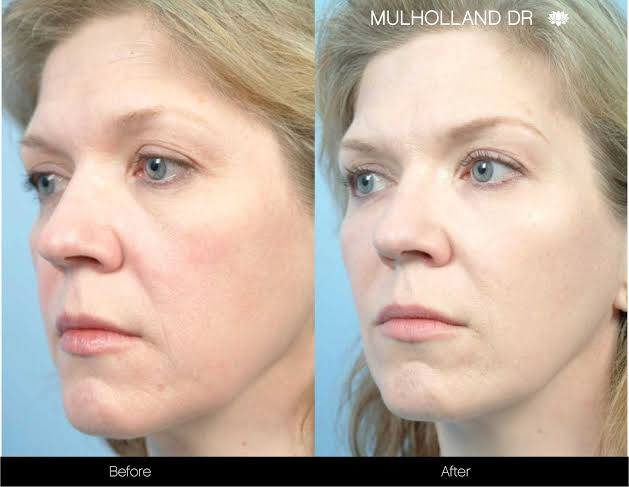 Fractional laser tips before and after for a guaranteed result