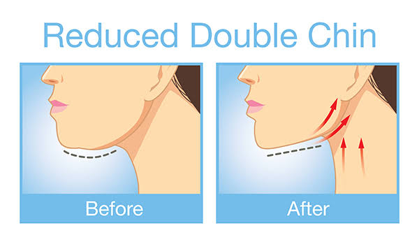Tricks to get rid of a double chin without cosmetic surgery