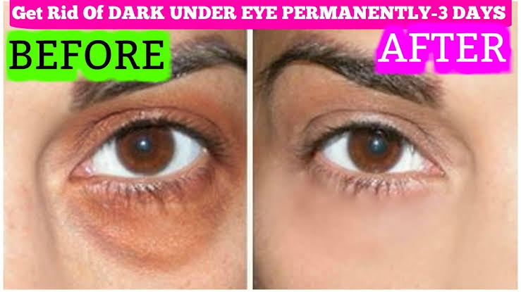 No one knew he would be saved from dark circles! Here are 2 ways that will be good for under-eye bruises