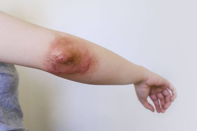 7 tips to help you prevent eczema and protect the skin from inflammation