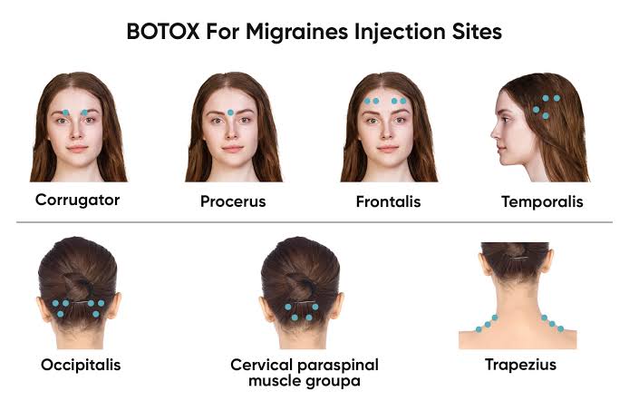 What is migraine botox, are there side effects? Who can get it done? Curious questions about migraine botox
