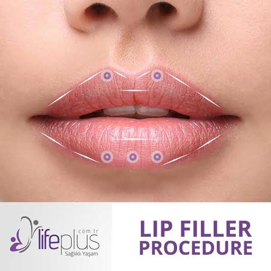 What should be considered in the lip filling process?