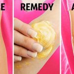 Get rid of dry elbows in natural ways