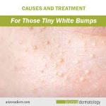 What Are the Little White Bumps on Our Skin? How is it Treated?