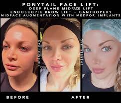 The world-famous “ponytail” method for lifting the face! 