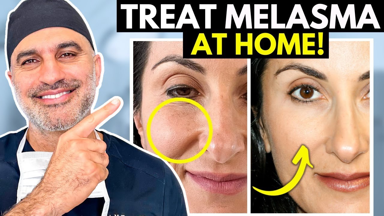 MELASMA