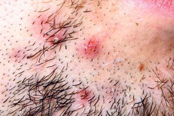 How can I avoid skin irritation after hair removal?