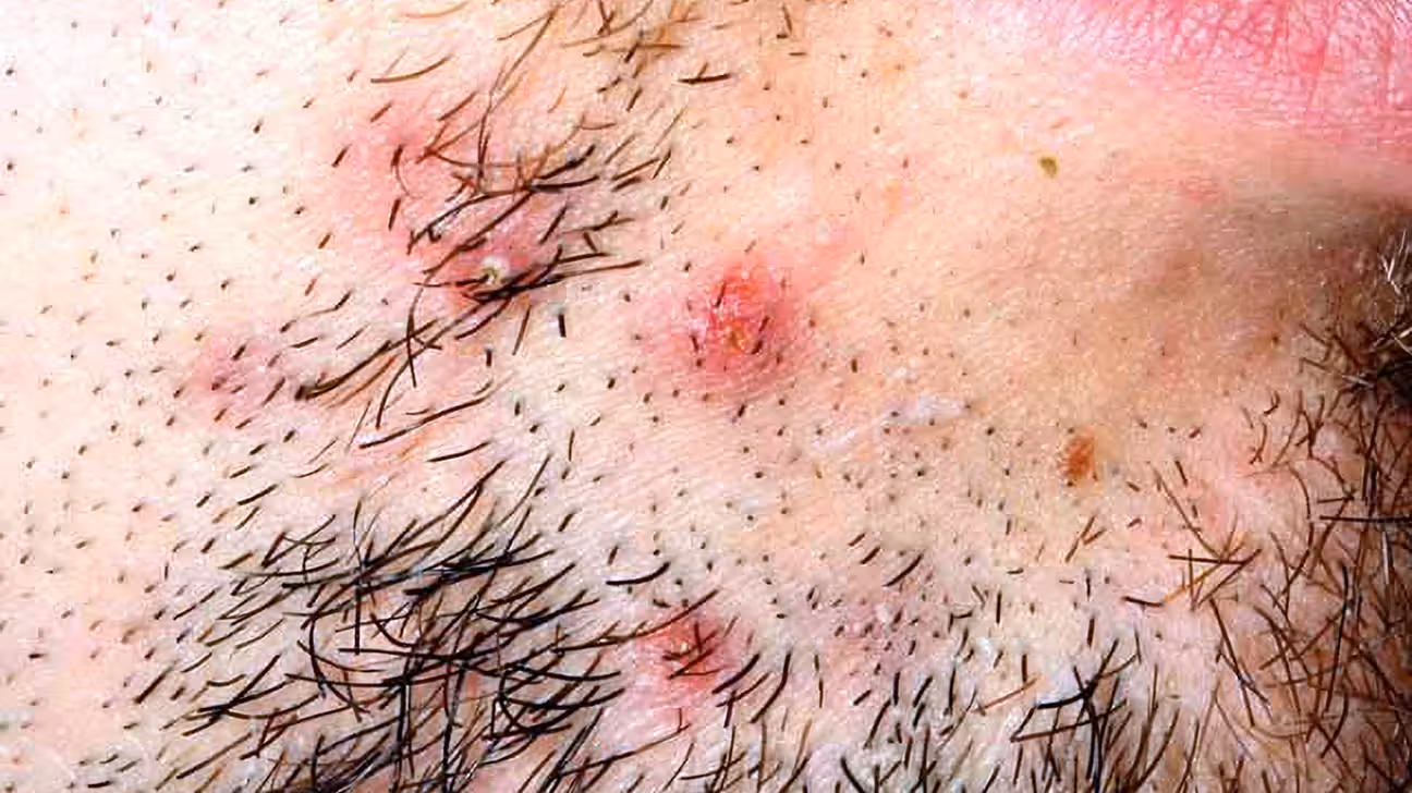 How can I avoid skin irritation after hair removal?