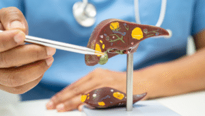 Non-alcoholic fatty liver disease: 3 medicinal plants that can help you